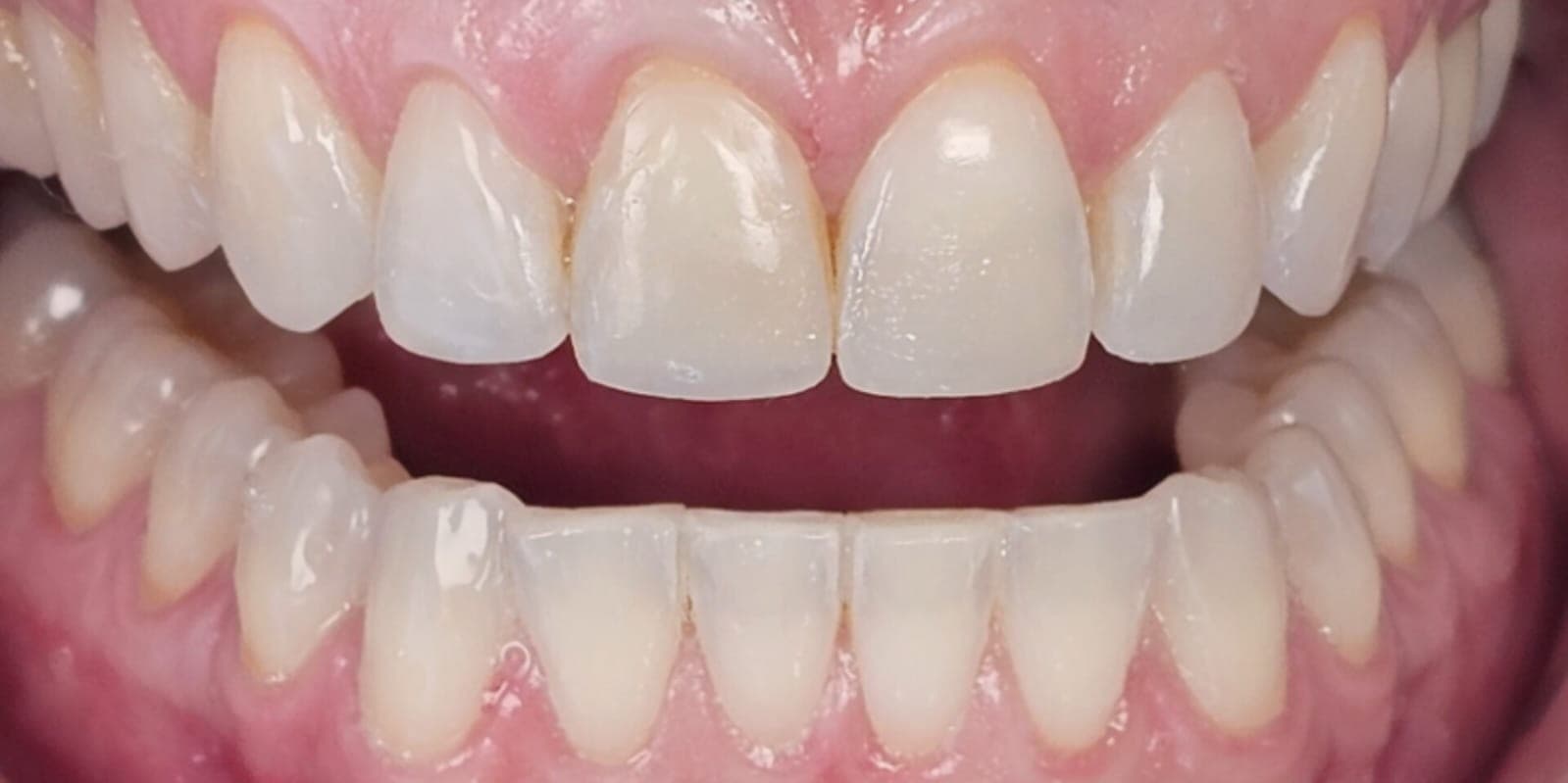 Resultado após clareamento dental especializado e harmonização estética