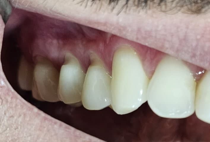 Dentes com perda de estrutura cervical e sensibilidade antes do preenchimento