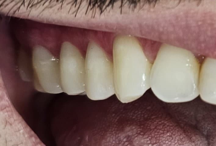 Recuperação anatômica com preenchimento em resina composta estratificada