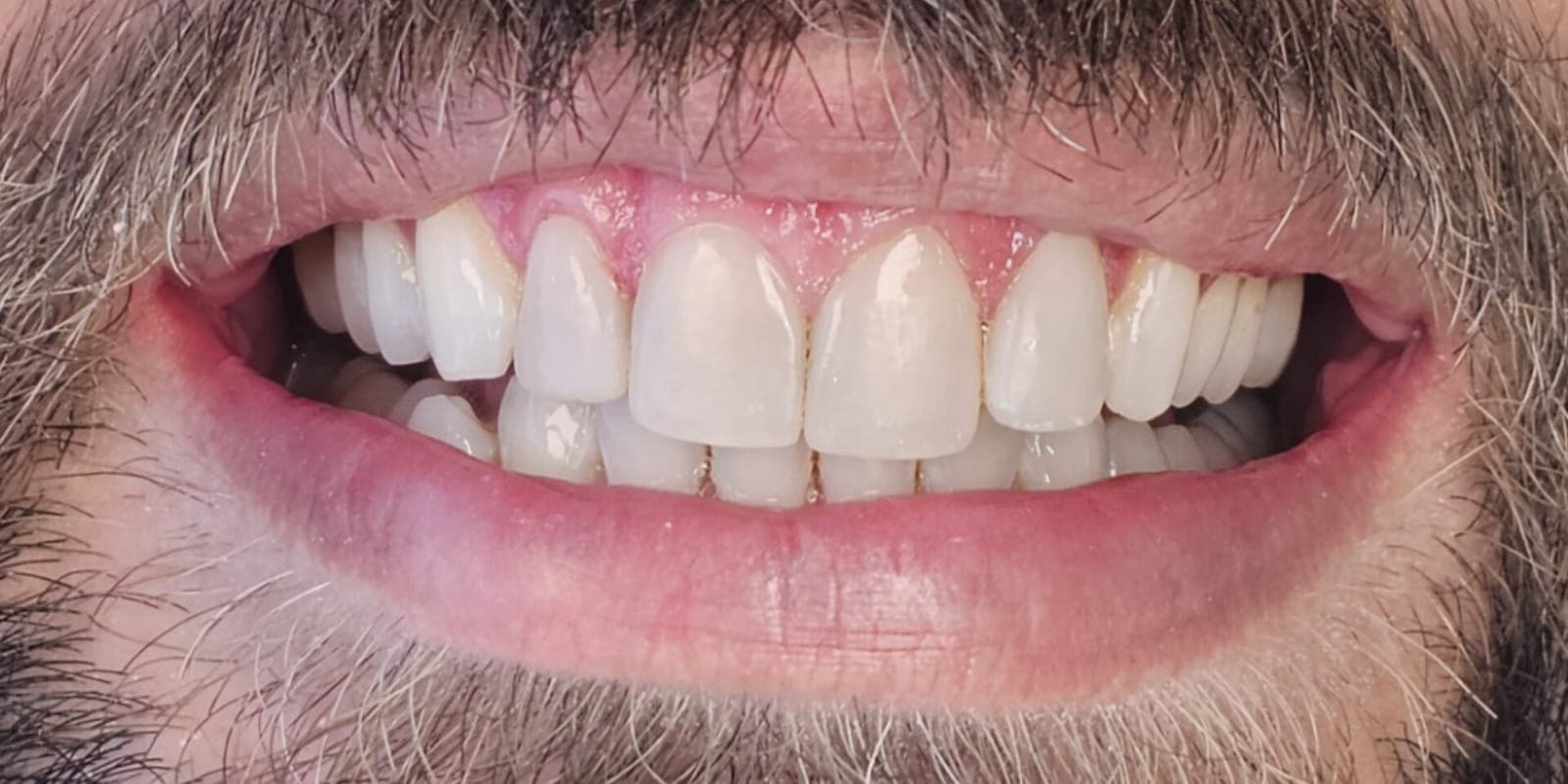 Transformação estética masculina com lentes e resina composta