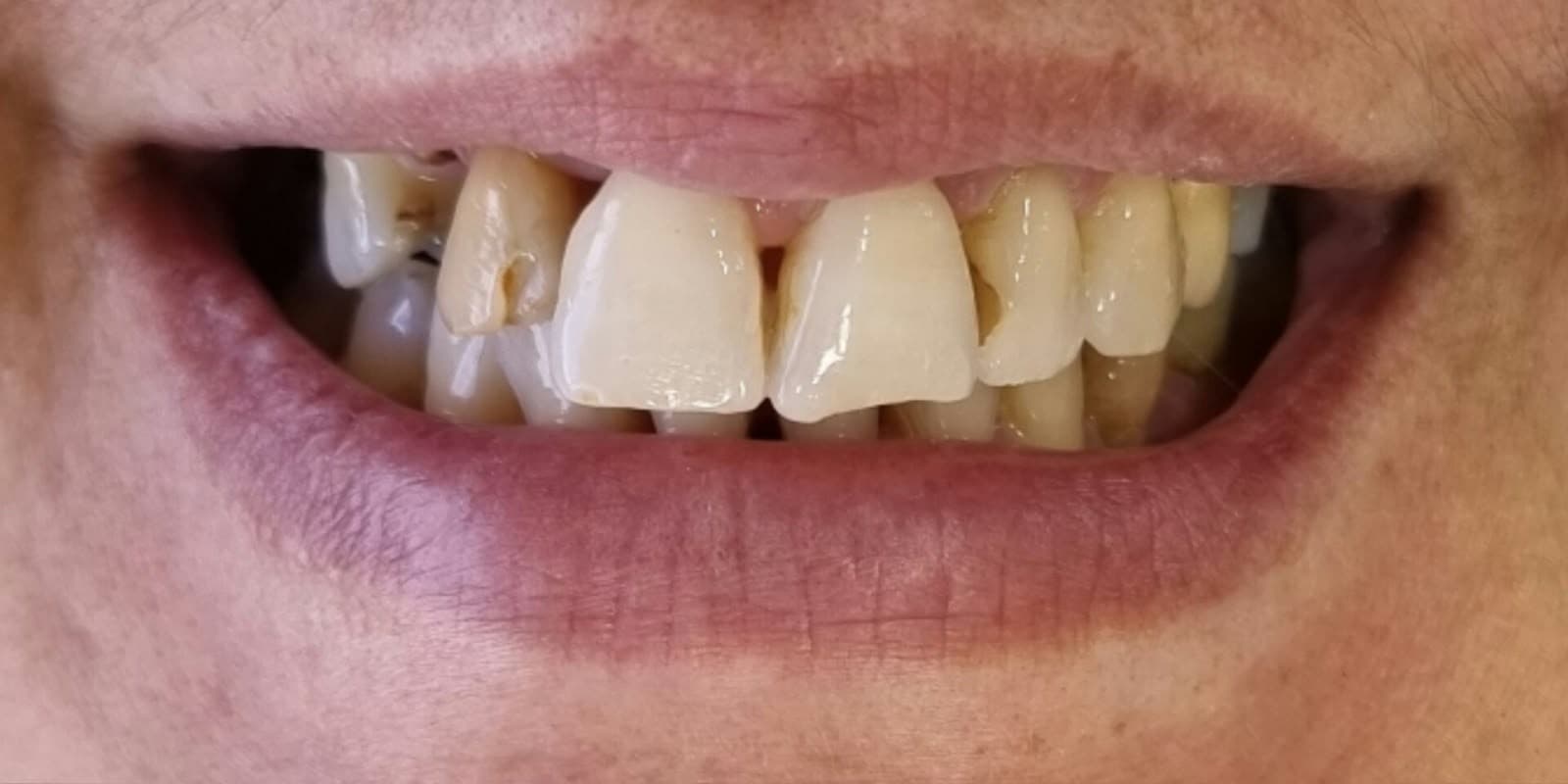 Dentes anteriores com desgastes, espaçamento e alterações estéticas