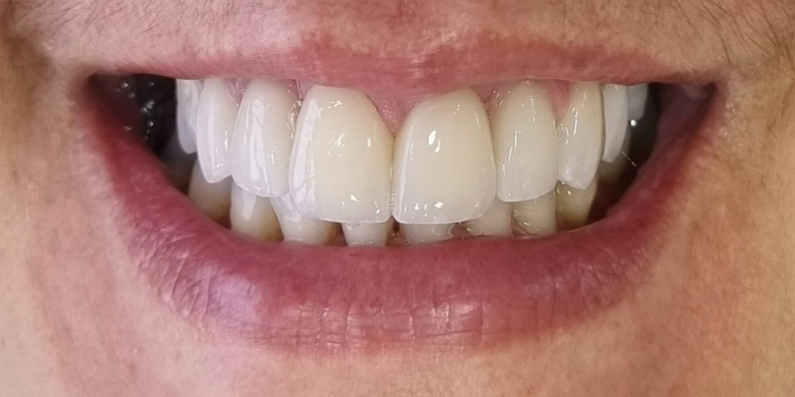 Rejuvenescimento do sorriso com lentes e resina de alta fidelidade