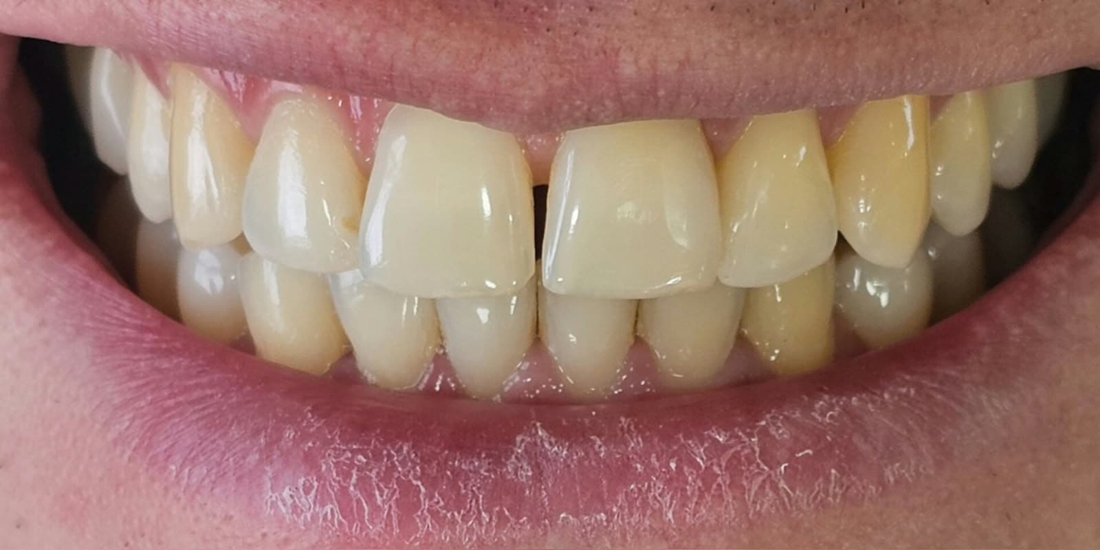 Dentes com espaçamento frontal (diastema) antes do procedimento
