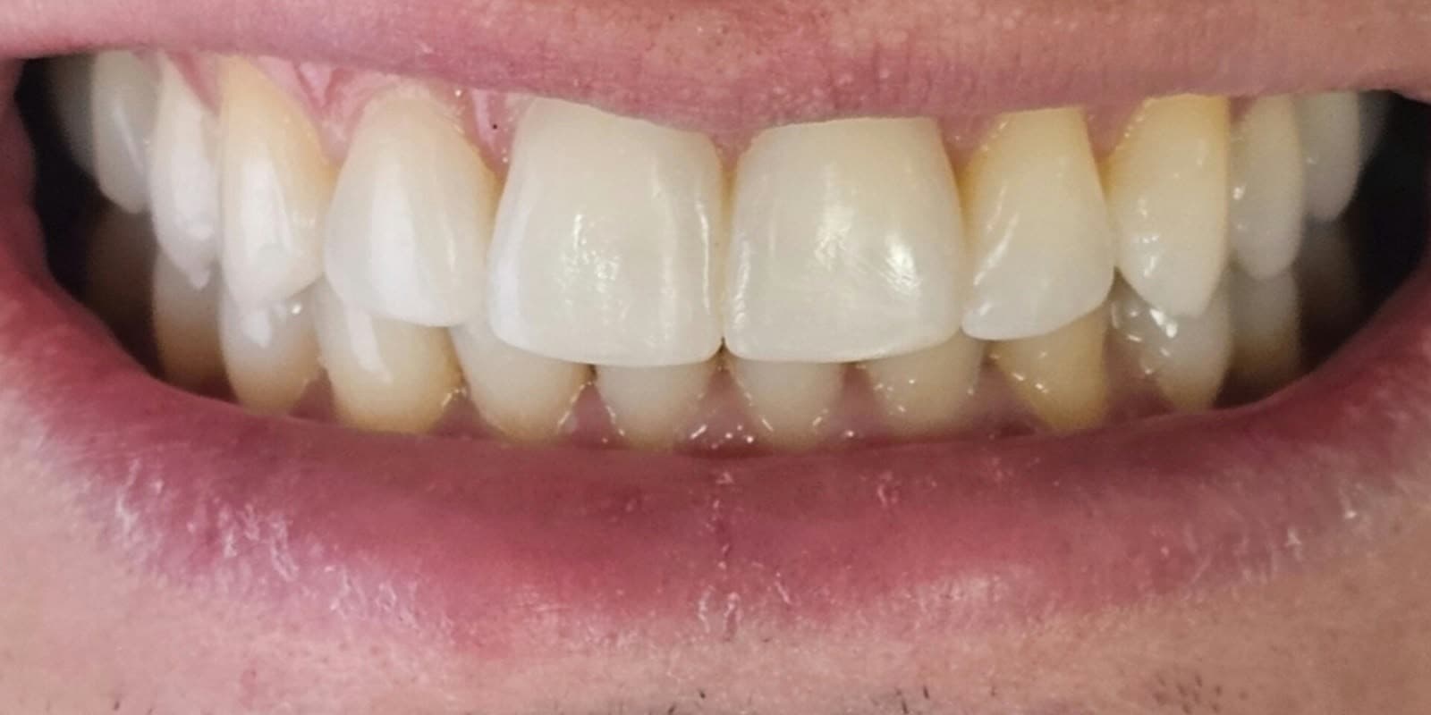 Fechamento de diastema com resina composta direta e iluminação dental