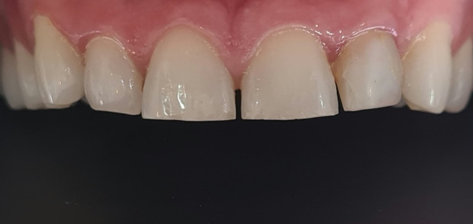 Bordas incisais desgastadas e diastema entre incisivos centrais