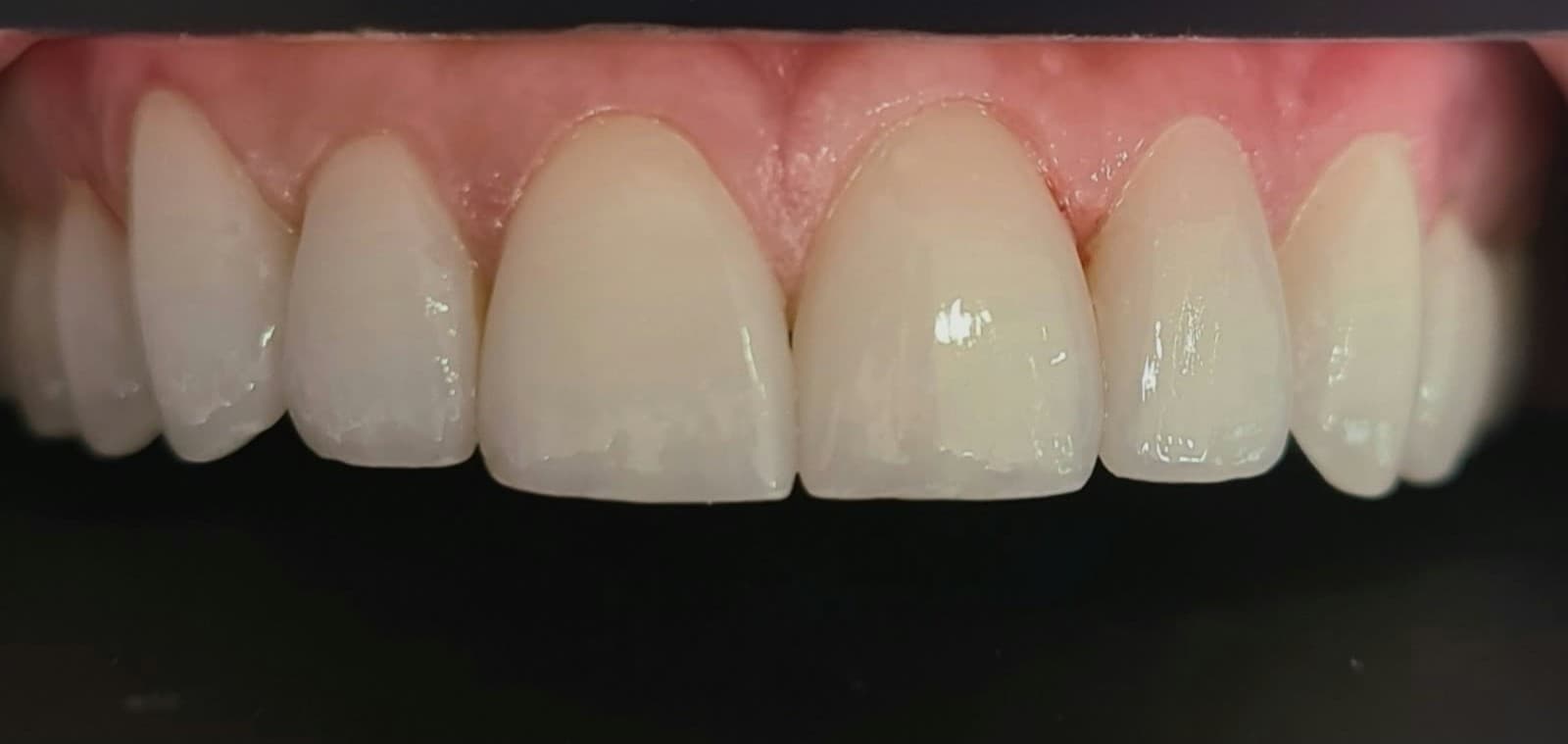 Reanatomização de bordas incisais e fechamento harmônico do sorriso