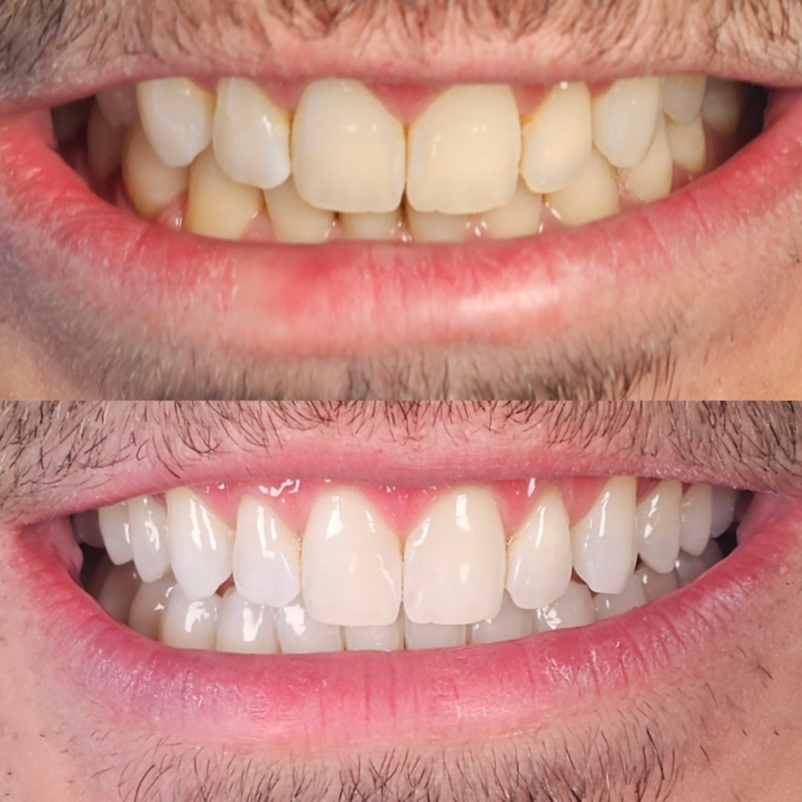 Antes e depois de clareamento dental na M.S Clinic — dentes mais claros e uniformes