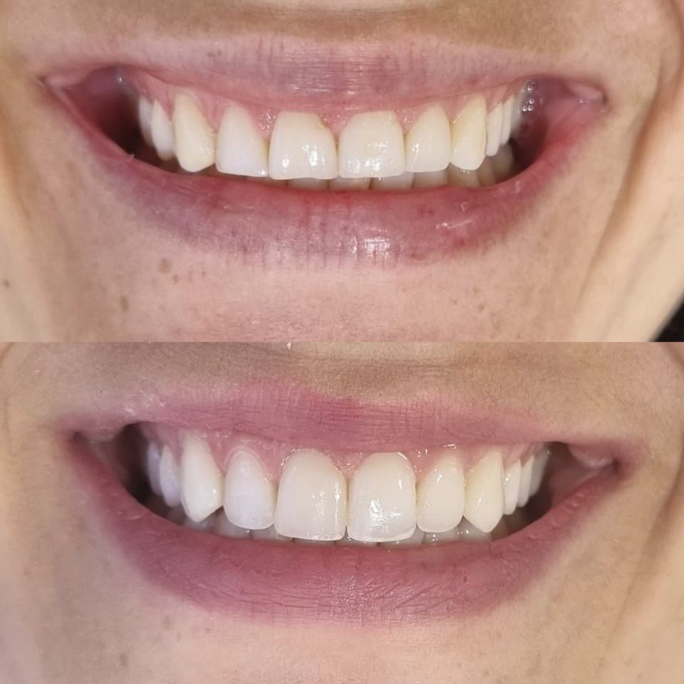 Antes e depois de restaurações estéticas na M.S Clinic — recontorno e harmonização do sorriso