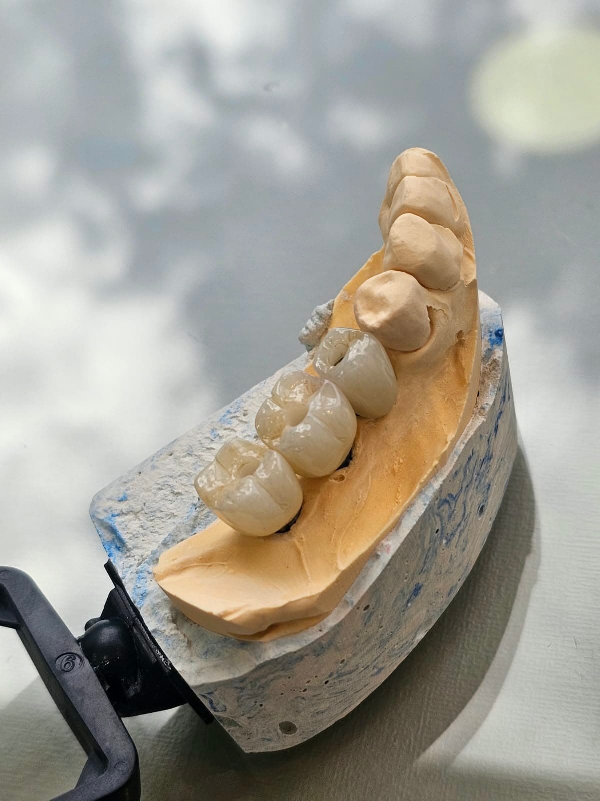 Coroas em porcelana pura sobre modelo de gesso, confeccionadas para reabilitação na M.S Clinic